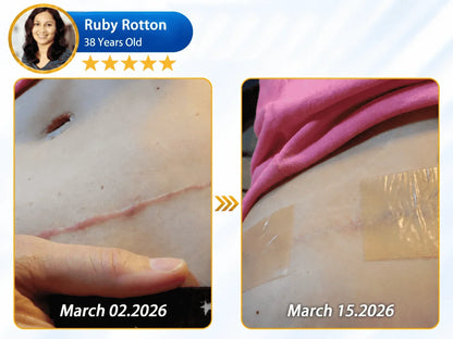 𝐎𝐟𝐟𝐢𝐜𝐢𝐚𝐥 𝐒𝐭𝐨𝐫𝐞 ②丨Mrevbsin® 🩹 Bio-Regenerative Microneedle Scar Tape——Remove all kinds of skin scars
