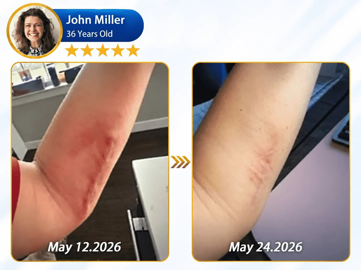 𝐎𝐟𝐟𝐢𝐜𝐢𝐚𝐥 𝐒𝐭𝐨𝐫𝐞 ②丨Mrevbsin® 🩹 Bio-Regenerative Microneedle Scar Tape——Remove all kinds of skin scars