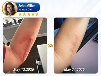 𝐎𝐟𝐟𝐢𝐜𝐢𝐚𝐥 𝐒𝐭𝐨𝐫𝐞 ②丨Mrevbsin® 🩹 Bio-Regenerative Microneedle Scar Tape——Remove all kinds of skin scars