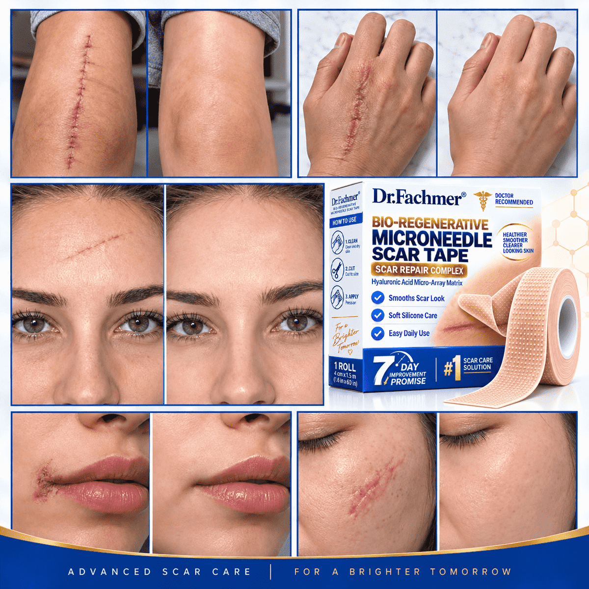 𝐎𝐟𝐟𝐢𝐜𝐢𝐚𝐥 𝐒𝐭𝐨𝐫𝐞 ②丨Mrevbsin® 🩹 Bio-Regenerative Microneedle Scar Tape——Remove all kinds of skin scars