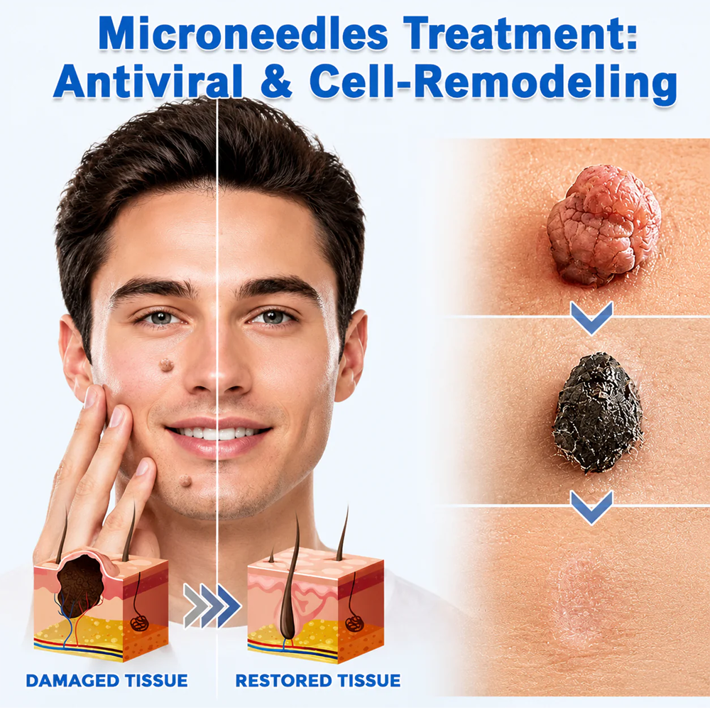 𝐎𝐟𝐟𝐢𝐜𝐢𝐚𝐥 𝐒𝐭𝐨𝐫𝐞 | Mrevbsin®  👩‍⚕️𝐁𝐨𝐭𝐚𝐧𝐢𝐜𝐚𝐥 𝐌𝐢𝐜𝐫𝐨𝐧𝐞𝐞𝐝𝐥𝐞 𝐇𝐲𝐝𝐫𝐨𝐜𝐨𝐥𝐥𝐨𝐢𝐝 𝐏𝐚𝐭𝐜𝐡 (𝐅𝐨𝐫 𝐒𝐤𝐢𝐧 𝐓𝐚𝐠𝐬, 𝐒𝐦𝐚𝐥𝐥 𝐒𝐤𝐢𝐧 𝐆𝐫𝐨𝐰𝐭𝐡𝐬, 𝐖𝐚𝐫𝐭𝐬, 𝐌𝐨𝐥𝐞𝐬, 𝐀𝐠𝐞 𝐒𝐩𝐨𝐭𝐬 & 𝐏𝐢𝐠𝐦𝐞𝐧𝐭𝐚𝐭𝐢𝐨𝐧 𝐂𝐨𝐧𝐜𝐞𝐫𝐧𝐬)