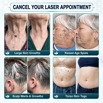𝐎𝐟𝐟𝐢𝐜𝐢𝐚𝐥 𝐒𝐭𝐨𝐫𝐞 | Mrevbsin®  👩‍⚕️𝐁𝐨𝐭𝐚𝐧𝐢𝐜𝐚𝐥 𝐌𝐢𝐜𝐫𝐨𝐧𝐞𝐞𝐝𝐥𝐞 𝐇𝐲𝐝𝐫𝐨𝐜𝐨𝐥𝐥𝐨𝐢𝐝 𝐏𝐚𝐭𝐜𝐡 (𝐅𝐨𝐫 𝐒𝐤𝐢𝐧 𝐓𝐚𝐠𝐬, 𝐒𝐦𝐚𝐥𝐥 𝐒𝐤𝐢𝐧 𝐆𝐫𝐨𝐰𝐭𝐡𝐬, 𝐖𝐚𝐫𝐭𝐬, 𝐌𝐨𝐥𝐞𝐬, 𝐀𝐠𝐞 𝐒𝐩𝐨𝐭𝐬 & 𝐏𝐢𝐠𝐦𝐞𝐧𝐭𝐚𝐭𝐢𝐨𝐧 𝐂𝐨𝐧𝐜𝐞𝐫𝐧𝐬)
