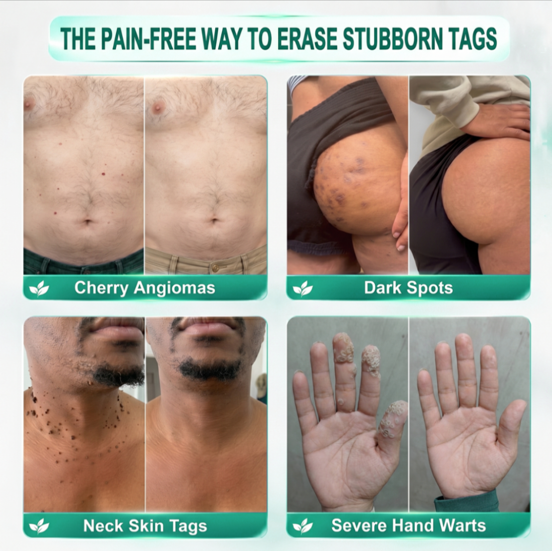 𝐎𝐟𝐟𝐢𝐜𝐢𝐚𝐥 𝐒𝐭𝐨𝐫𝐞 | Mrevbsin®  👩‍⚕️𝐁𝐨𝐭𝐚𝐧𝐢𝐜𝐚𝐥 𝐌𝐢𝐜𝐫𝐨𝐧𝐞𝐞𝐝𝐥𝐞 𝐇𝐲𝐝𝐫𝐨𝐜𝐨𝐥𝐥𝐨𝐢𝐝 𝐏𝐚𝐭𝐜𝐡 (𝐅𝐨𝐫 𝐒𝐤𝐢𝐧 𝐓𝐚𝐠𝐬, 𝐒𝐦𝐚𝐥𝐥 𝐒𝐤𝐢𝐧 𝐆𝐫𝐨𝐰𝐭𝐡𝐬, 𝐖𝐚𝐫𝐭𝐬, 𝐌𝐨𝐥𝐞𝐬, 𝐀𝐠𝐞 𝐒𝐩𝐨𝐭𝐬 & 𝐏𝐢𝐠𝐦𝐞𝐧𝐭𝐚𝐭𝐢𝐨𝐧 𝐂𝐨𝐧𝐜𝐞𝐫𝐧𝐬)