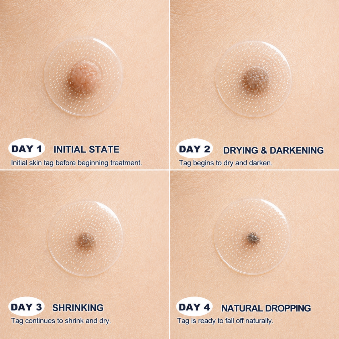 𝐎𝐟𝐟𝐢𝐜𝐢𝐚𝐥 𝐒𝐭𝐨𝐫𝐞 | Mrevbsin®  👩‍⚕️𝐁𝐨𝐭𝐚𝐧𝐢𝐜𝐚𝐥 𝐌𝐢𝐜𝐫𝐨𝐧𝐞𝐞𝐝𝐥𝐞 𝐇𝐲𝐝𝐫𝐨𝐜𝐨𝐥𝐥𝐨𝐢𝐝 𝐏𝐚𝐭𝐜𝐡 (𝐅𝐨𝐫 𝐒𝐤𝐢𝐧 𝐓𝐚𝐠𝐬, 𝐒𝐦𝐚𝐥𝐥 𝐒𝐤𝐢𝐧 𝐆𝐫𝐨𝐰𝐭𝐡𝐬, 𝐖𝐚𝐫𝐭𝐬, 𝐌𝐨𝐥𝐞𝐬, 𝐀𝐠𝐞 𝐒𝐩𝐨𝐭𝐬 & 𝐏𝐢𝐠𝐦𝐞𝐧𝐭𝐚𝐭𝐢𝐨𝐧 𝐂𝐨𝐧𝐜𝐞𝐫𝐧𝐬)