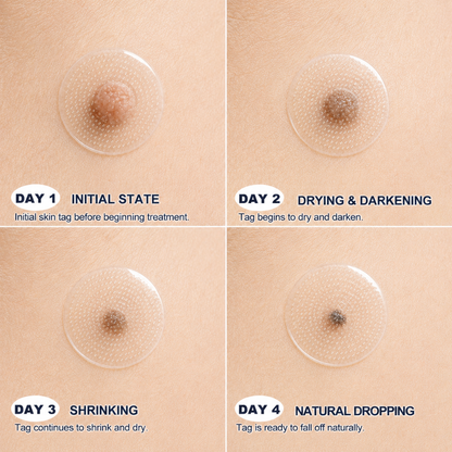 𝐎𝐟𝐟𝐢𝐜𝐢𝐚𝐥 𝐒𝐭𝐨𝐫𝐞 | Mrevbsin®  👩‍⚕️𝐁𝐨𝐭𝐚𝐧𝐢𝐜𝐚𝐥 𝐌𝐢𝐜𝐫𝐨𝐧𝐞𝐞𝐝𝐥𝐞 𝐇𝐲𝐝𝐫𝐨𝐜𝐨𝐥𝐥𝐨𝐢𝐝 𝐏𝐚𝐭𝐜𝐡 (𝐅𝐨𝐫 𝐒𝐤𝐢𝐧 𝐓𝐚𝐠𝐬, 𝐒𝐦𝐚𝐥𝐥 𝐒𝐤𝐢𝐧 𝐆𝐫𝐨𝐰𝐭𝐡𝐬, 𝐖𝐚𝐫𝐭𝐬, 𝐌𝐨𝐥𝐞𝐬, 𝐀𝐠𝐞 𝐒𝐩𝐨𝐭𝐬 & 𝐏𝐢𝐠𝐦𝐞𝐧𝐭𝐚𝐭𝐢𝐨𝐧 𝐂𝐨𝐧𝐜𝐞𝐫𝐧𝐬)